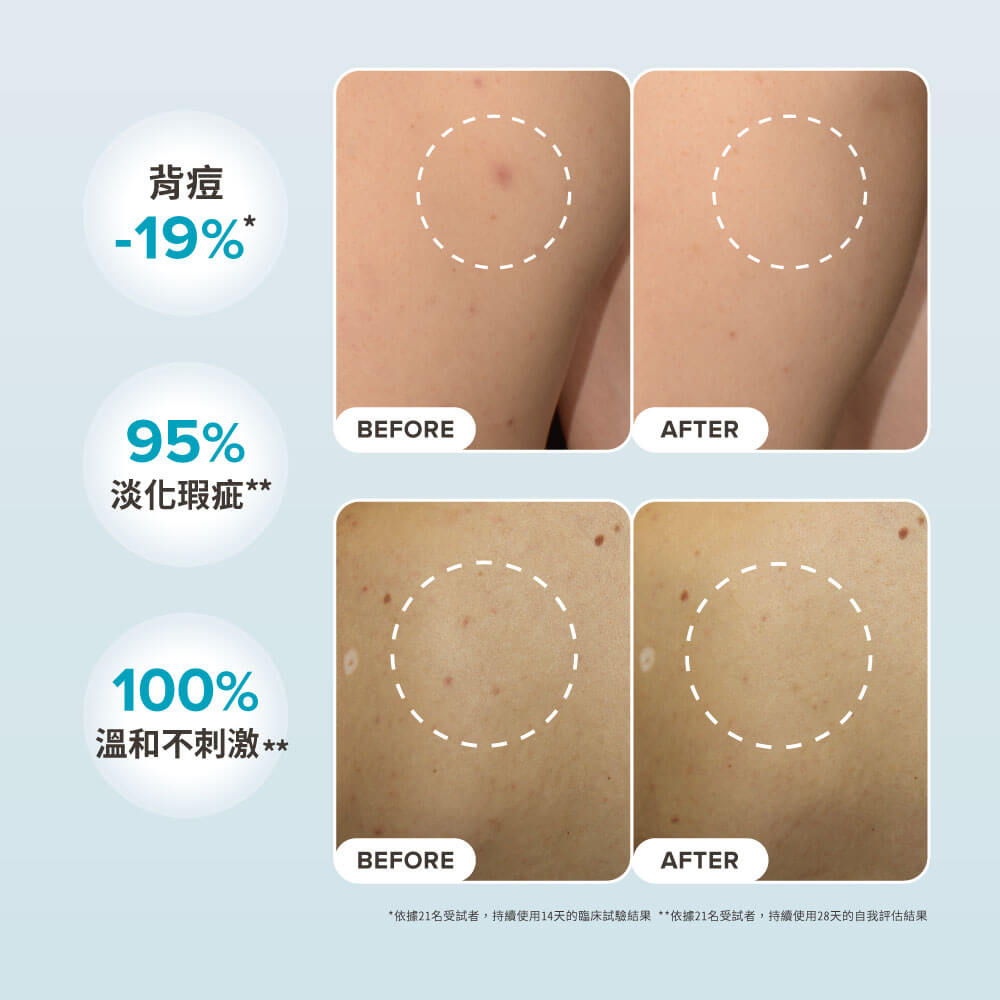 淨無痘2%水楊酸美體噴露